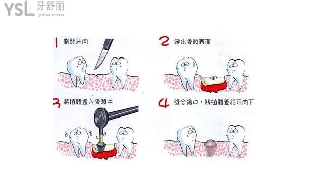 種植牙過程圖