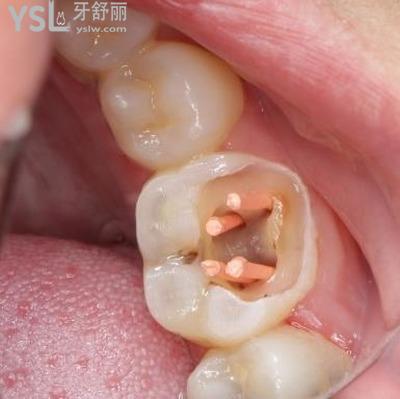 牙齒根管治療是什么意思？