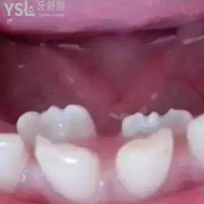 雙排牙齒要拔掉嗎?怎么治療？