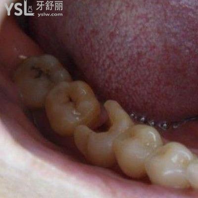 拔牙后根尖炎會消除嗎