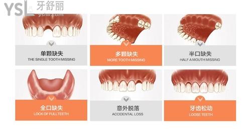 缺一顆牙齒怎么補(bǔ)好3