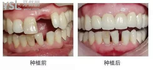 缺一顆牙齒種植牙修復(fù)成效