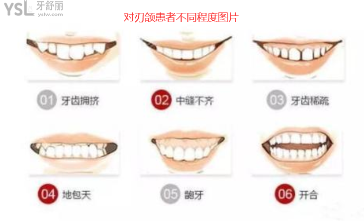 對刃頜的危害是什么，對刃頜矯正需要多少錢有必要嗎