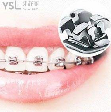 考生因戴金屬牙套不能進(jìn)考場(chǎng)不實(shí),新高三學(xué)生可以放心做金屬矯正器