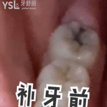 補(bǔ)牙