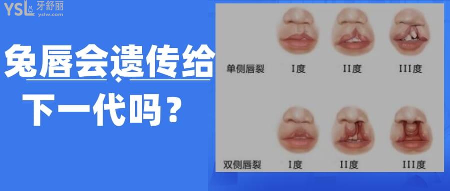 兔唇會(huì)遺傳給下一代嗎