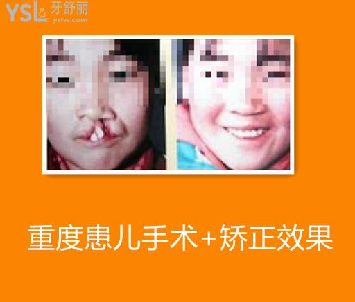 唇腭裂手術(shù)