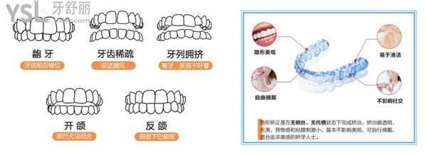 隱形矯正的優(yōu)勢(shì)