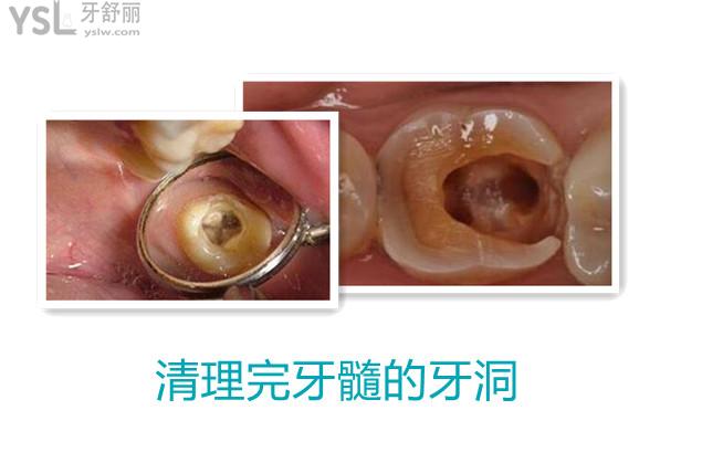 引起牙髓病的主要原因