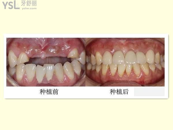 種植牙對比圖
