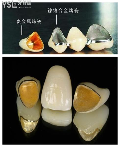 烤瓷牙的種類
