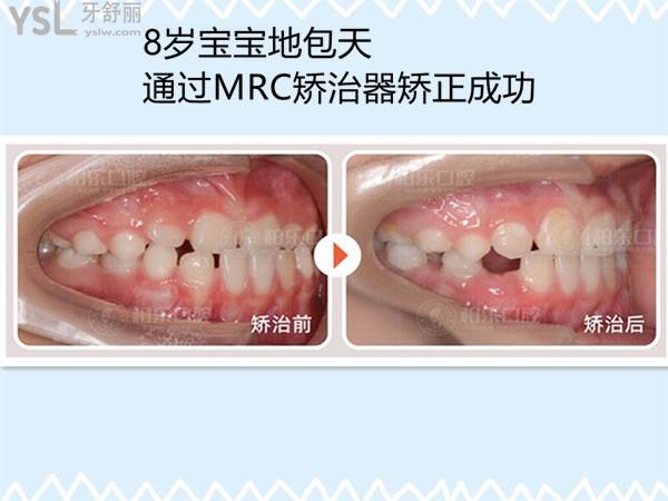 mrc矯正器矯正病例