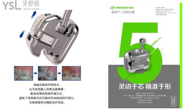 普特自鎖托槽矯正器優(yōu)勢(shì)