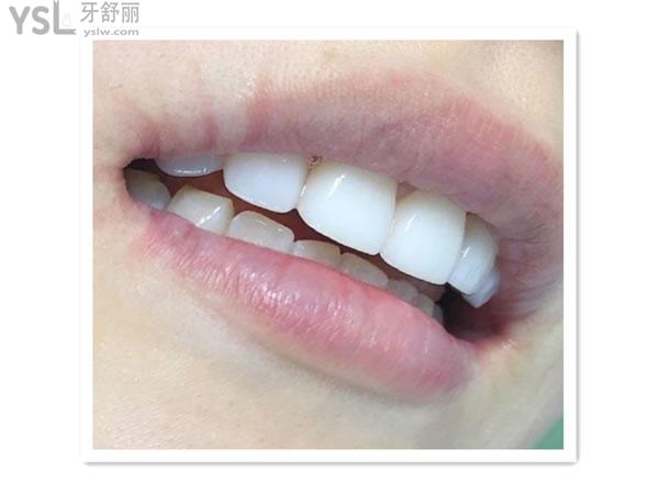 琥珀瓷貼面術(shù)后圖