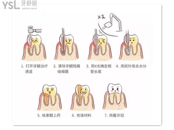 根管治療過程圖
