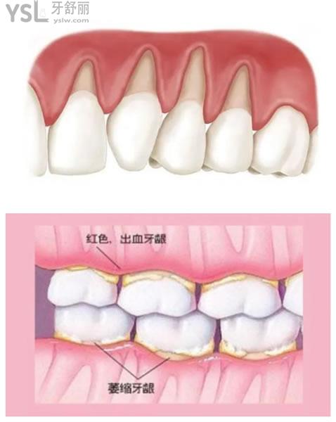 牙齦萎縮