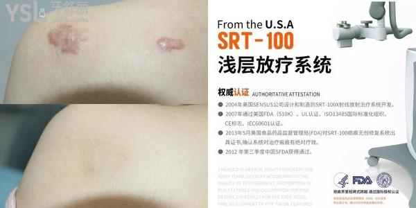 SRT100放療祛疤痕的費(fèi)用以及復(fù)發(fā)率怎么樣？