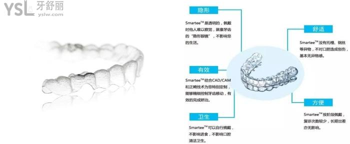 隱形牙套的優(yōu)點.jpg