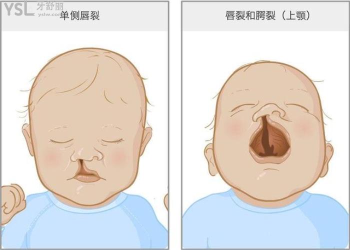 唇腭裂屬于什么遺傳??？.jpg