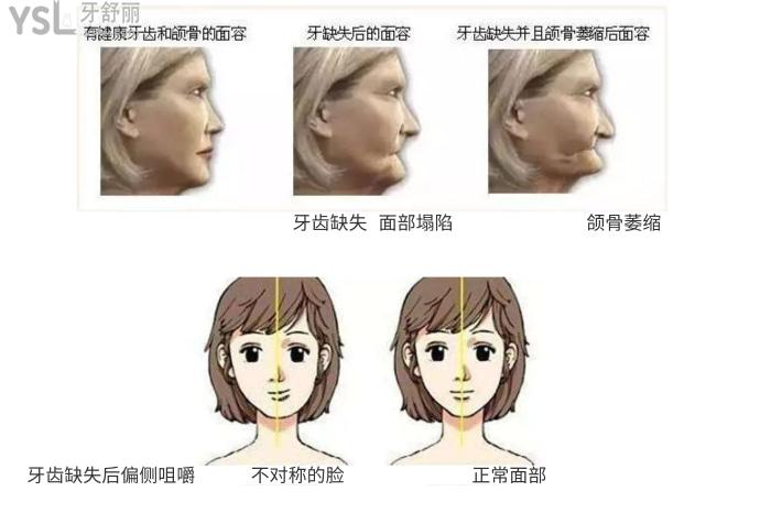 長期缺牙導(dǎo)致面部塌陷