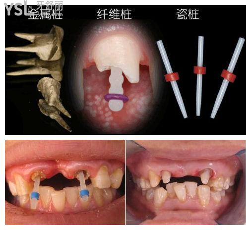 牙齒修復(fù)的幾種方法微樁是什么意思