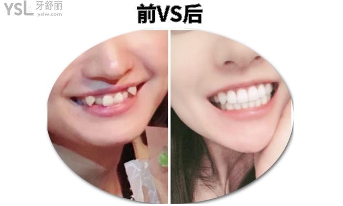 成人盡量不要矯正牙齒？究竟是有風(fēng)險(xiǎn)還是怕你<span style=