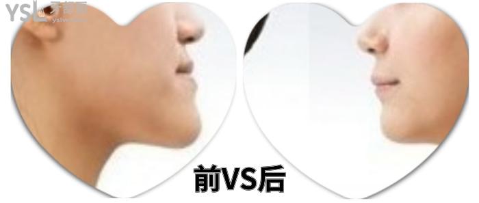 成人盡量不要矯正牙齒？究竟是有風(fēng)險(xiǎn)還是怕你<span style=