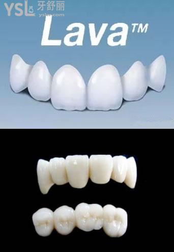 美國3M lawe全瓷牙