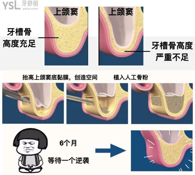 上頜竇內(nèi)提和外提手術過程