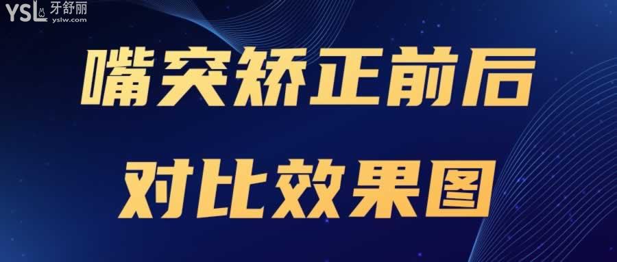 嘴突矯正前后對比圖