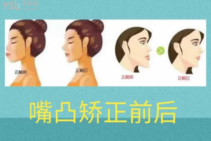 手術矯正嘴凸一般需要多少錢