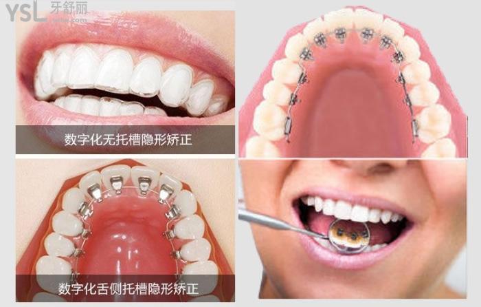 明星們喜歡用的舌側(cè)矯正器很貴嗎？大概多少錢(qián)呢？