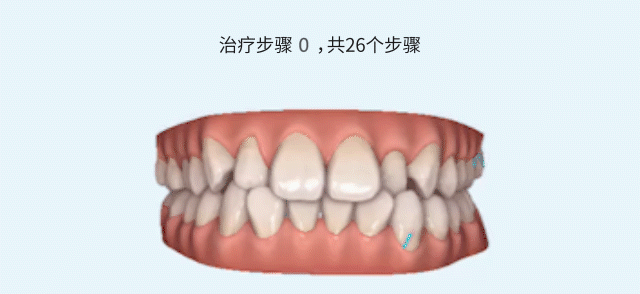 兒童早期矯正器的種類及價格公開