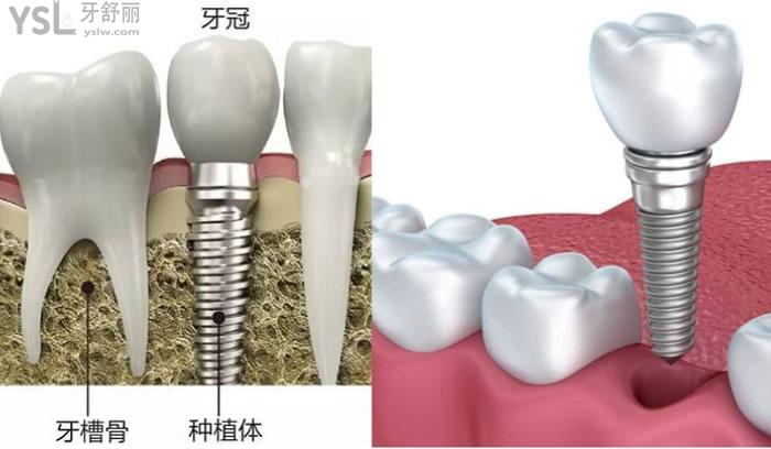 韶關(guān)矯正牙齒價格多少