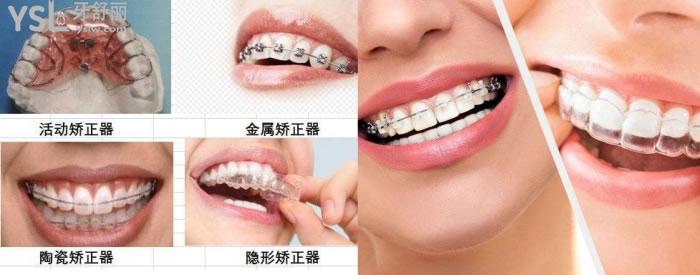 韶關(guān)矯正牙齒價格多少