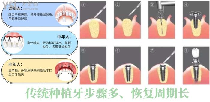 微創(chuàng)種植牙和普通種植牙區(qū)別是什么？要不要縫線？微創(chuàng)種植牙的利弊？