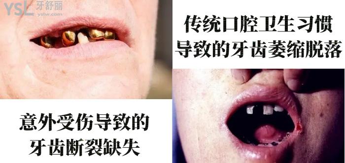 50歲做種植牙心酸歷程！種植牙6年后的真實感受100字親歷！