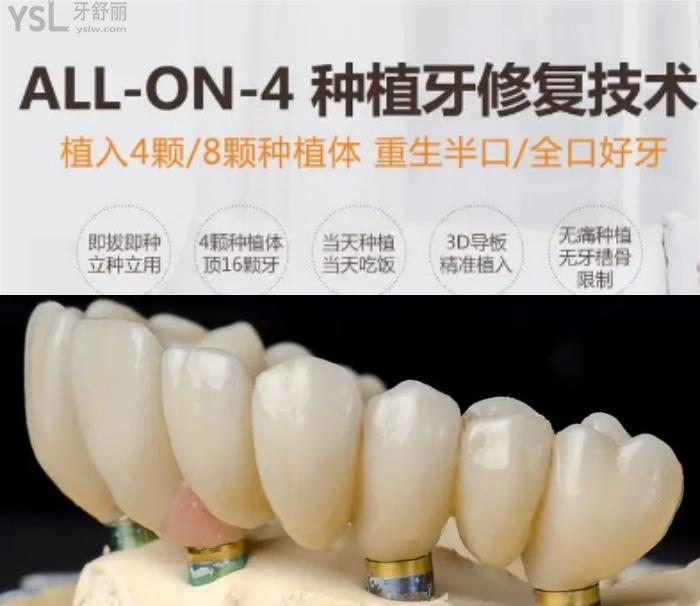 50歲做種植牙心酸歷程！種植牙6年后的真實感受100字親歷！