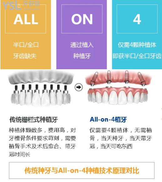 all-on-4種植牙優(yōu)勢(shì)