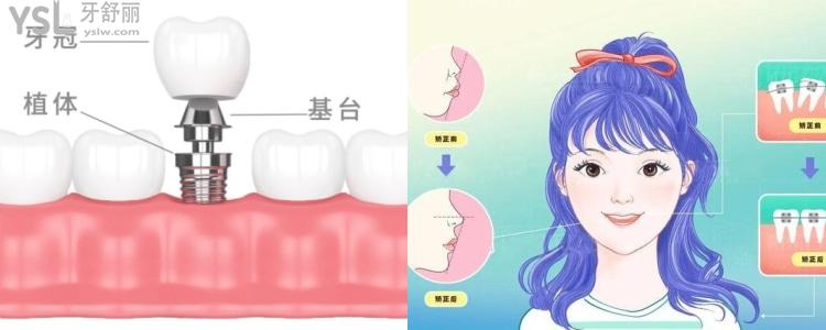 牙齒種植