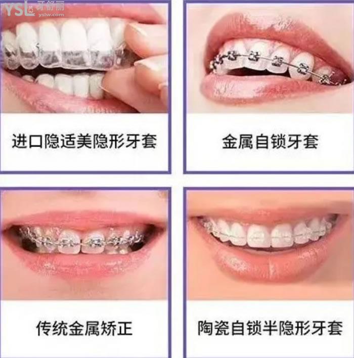 合肥隱形牙套價(jià)格