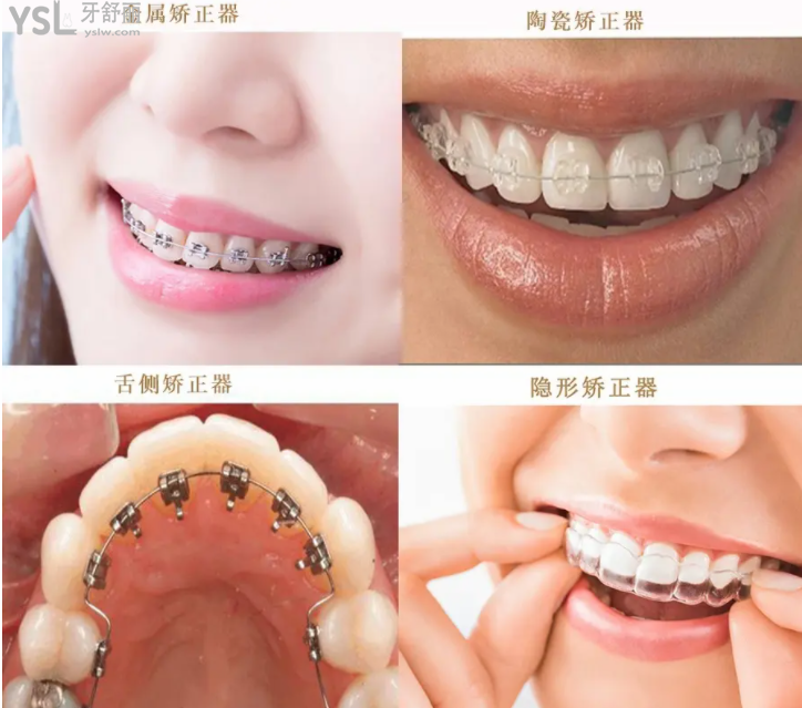 恩施凱恩口腔醫(yī)院隱適美25000元起啦，暑期矯正等你來(lái)~