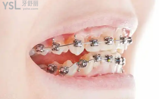 拿捏了！臨沂德貝口腔醫(yī)院六月正畸/潔牙/ 補牙/美牙/拔牙大促銷，牙齒矯正3999元/起，多重**享不停