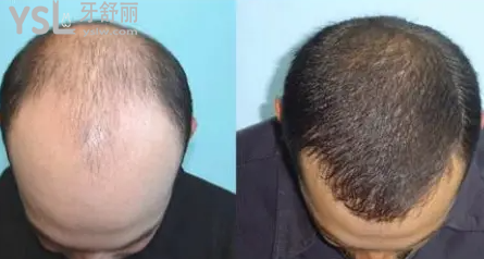 衡陽雅美父親節(jié)有植發(fā)活動，送父親禮物不如帶父親去植發(fā)，讓父親年輕持久