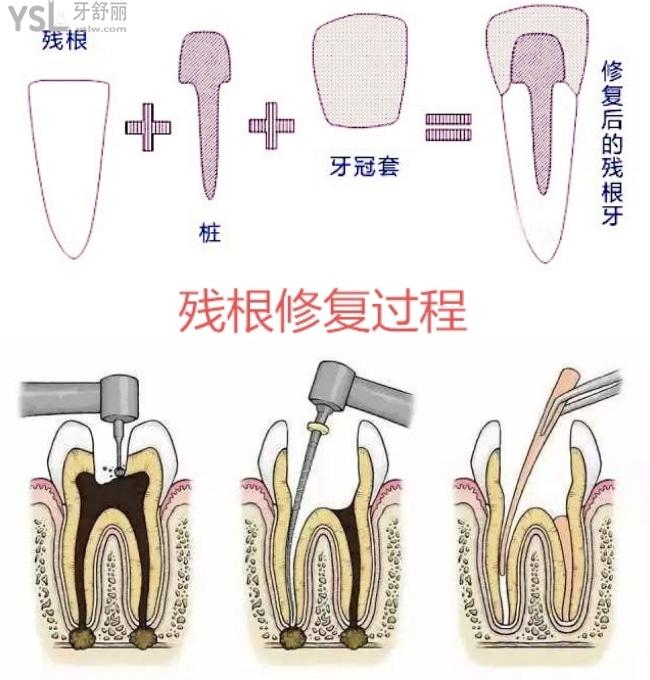 牙齒打樁