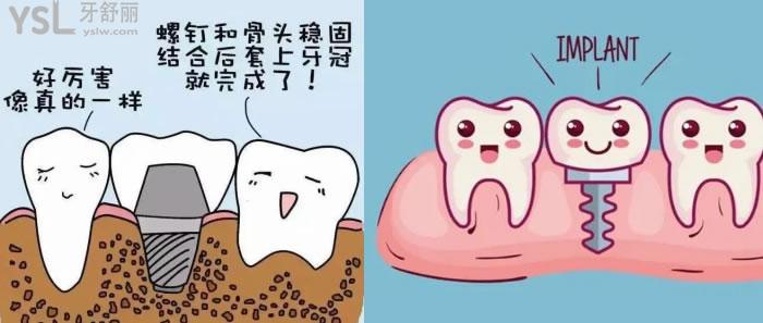 歐妮泰Basic種植體