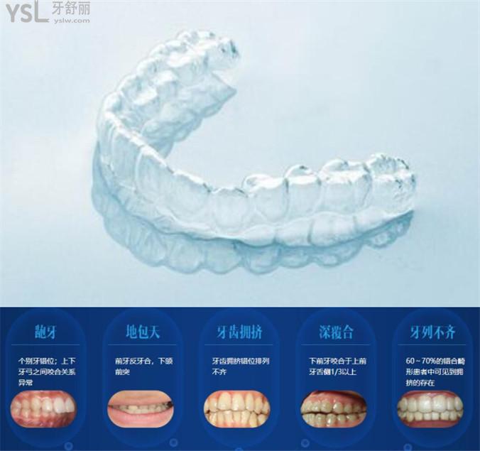 隱適美隱形矯治器多少錢(qián)？