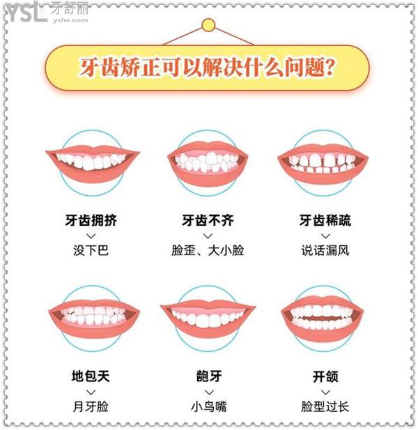 牙齒矯正可以解決啥問題