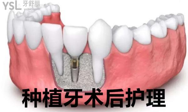 種植牙術(shù)后護(hù)理
