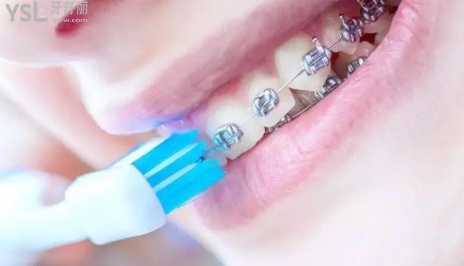 正畸正確刷牙